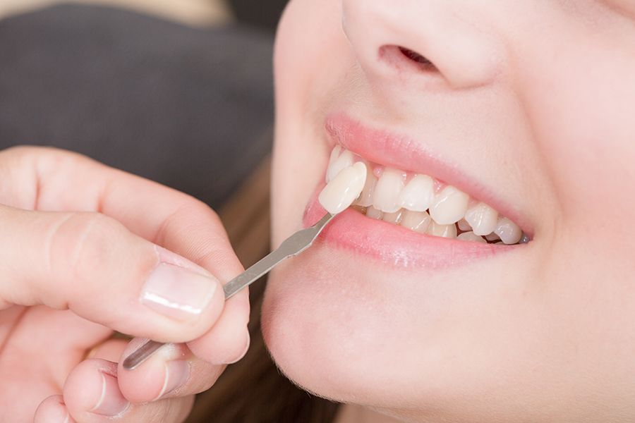 veneers2